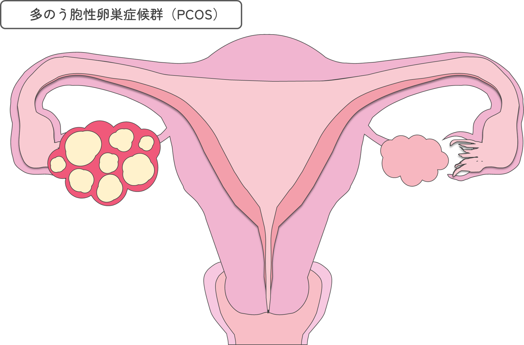 多嚢胞性卵巣症候群(PCOS)について